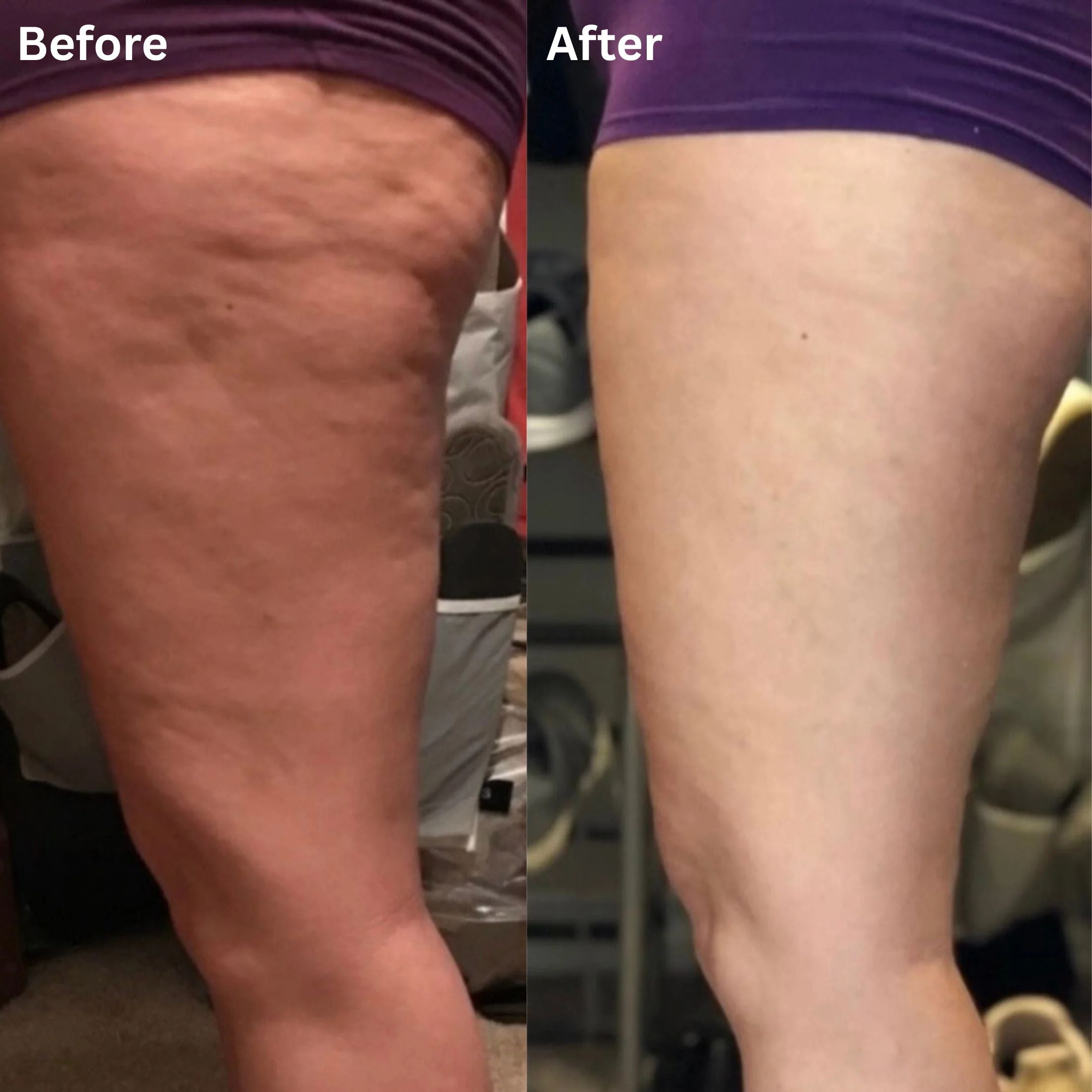 DimpleDrain™ Anti-Cellulite Sculpting Tool — Bye Bye Dimples, Hello Confidence!