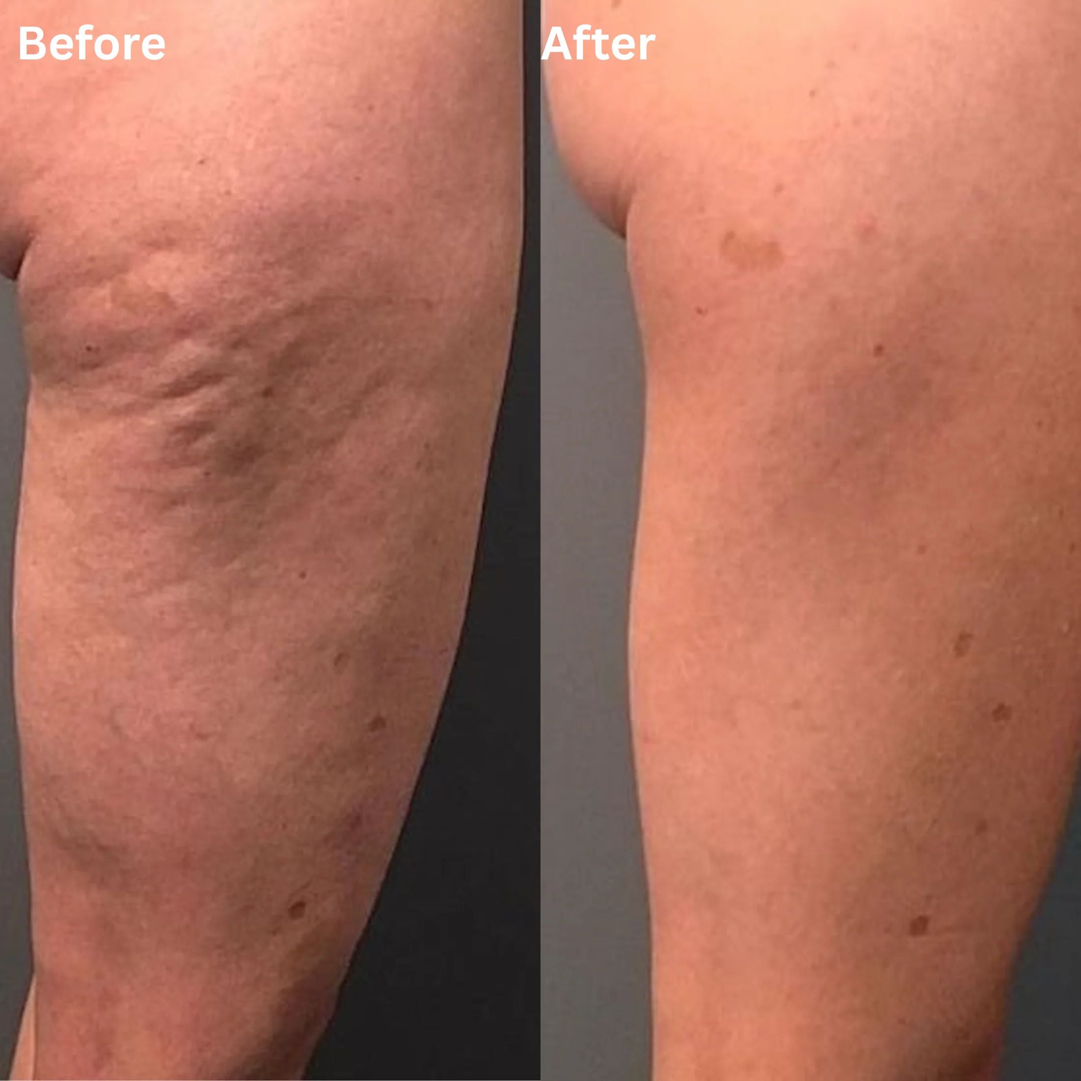 DimpleDrain™ Anti-Cellulite Sculpting Tool — Bye Bye Dimples, Hello Confidence!